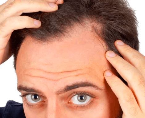 men giving   hair loss treatments  heading straight  transplants healthblogsorg