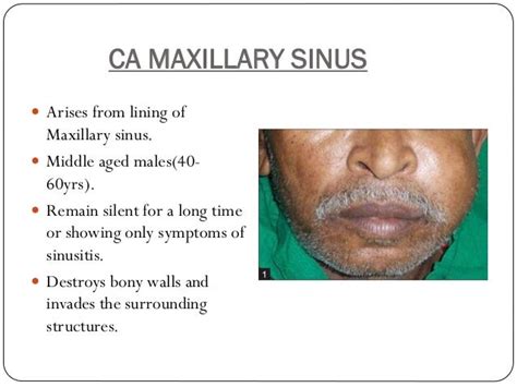 signs  symptoms  early sinusitis