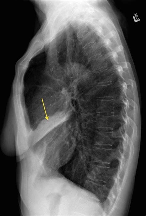 Right Middle Lobe Collapse Lateral Cxr Radiology At St Vincents
