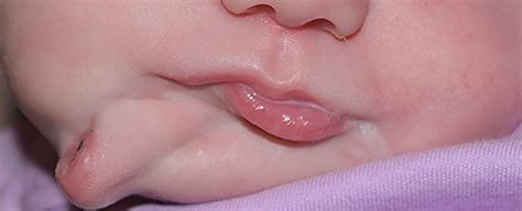 rare condition caused  baby   born    mouth