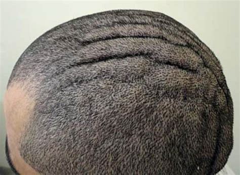 wrinkled scalp meaning   treatments skincarederm