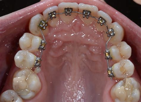 fixed gdp orthodontics dr andrew wallace