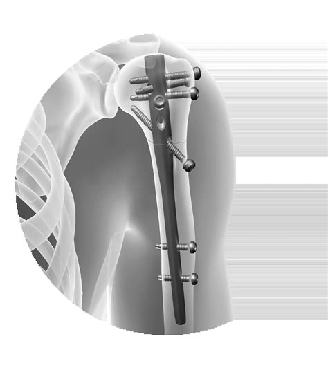 fracture shoulder solutions zimmer biomet