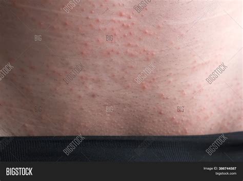 rash  skin man groin image photo  trial bigstock