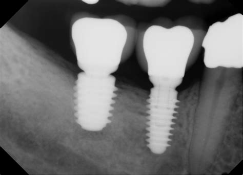 pacific smiles dental implant center   dental implants work