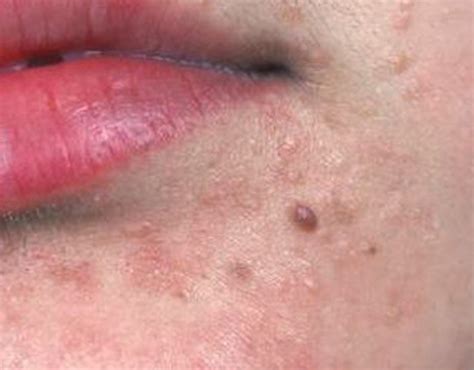 flat warts  face pictures treatment  removal