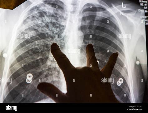 radiographer reviews  abnormal chest  ray  demonstrates  showing  suggests active