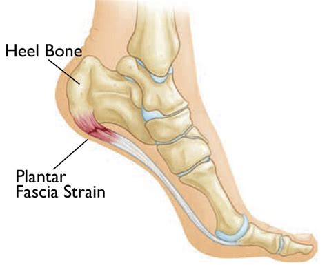 Physical Therapy And Plantar Fascia Pain Core Omaha Explains C O