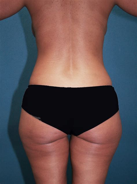 brazilian butt lift 30 brandon plastic surgery
