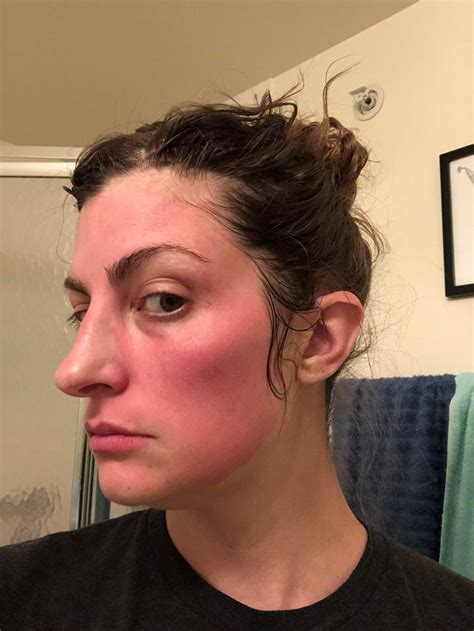 a redditor shared her allergic reaction story to remind people to patch