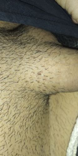 Is This A Mole Or A Wart Can You Please Help Me Sexual