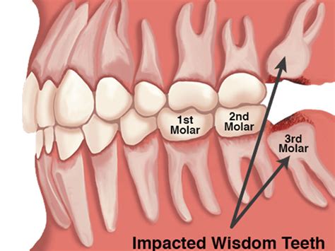 wisdom teeth       remove  meyer clinic