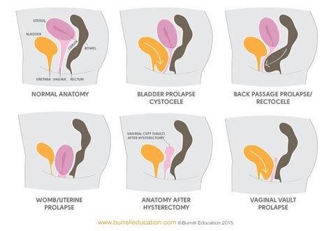 Types Of Pelvic Organ Prolapse Explained Holistic Core