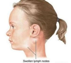 swollen glands  neck symptoms  treatment