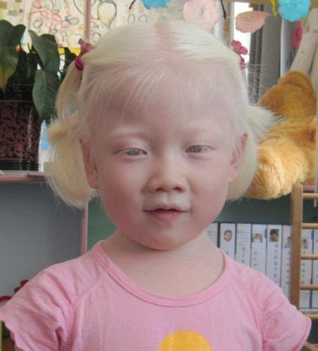 asian albinism google search albinism albino girl albino