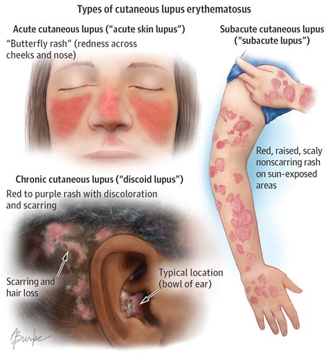 Cutaneous Lupus Erythematosus Dermatology Jama Dermatology Jama