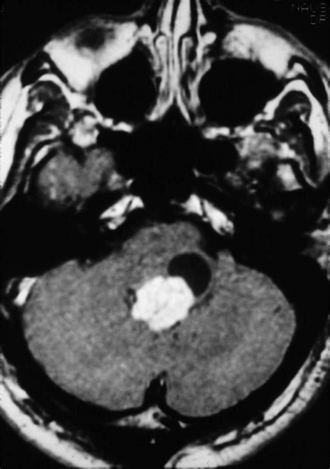 neurosurgery choroid plexus papilloma