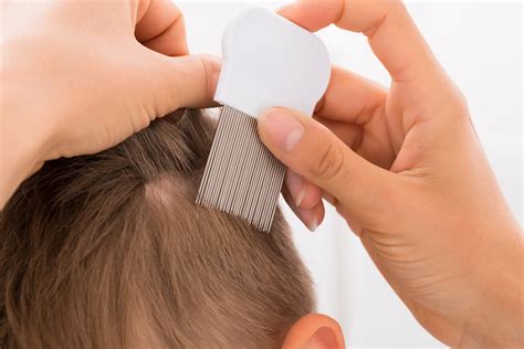 natural headlice treatments chemical  head lice solutions headlice removal