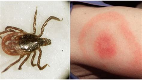 What Is Lyme Disease And What Are The Symptoms Of The Rapidly