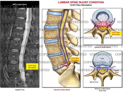 l5 s1 lumbar spine disc herniation with mri — medical art works