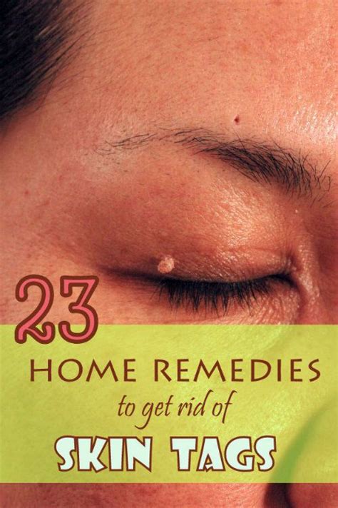 23 proven home remedies to get rid of skin tags skin