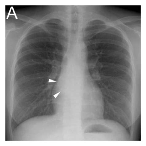 A Chest X Ray Image Showed A Mass Shadow In The Cardiac Silhouette