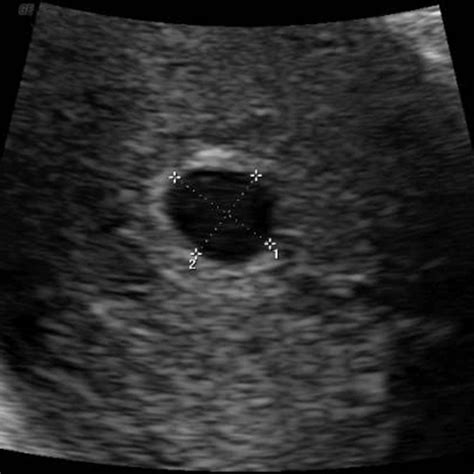 week 4 ultrasound what it would look like