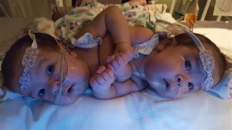 Sex lives of conjoined twins