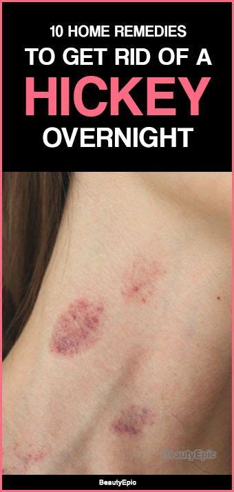 how to get rid of hickeys right now howtorem