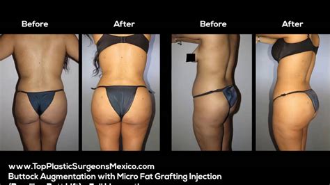 brazilian butt lift buttock augmentation with fat