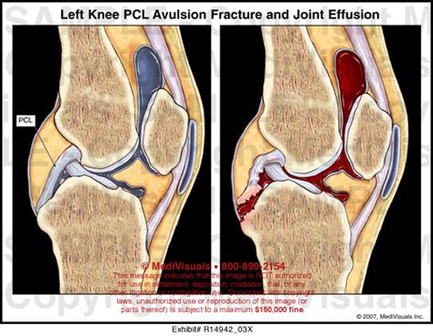 left knee pcl avulsion fracture  joint effusion medivisuals