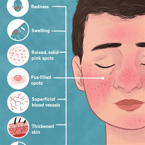 rosacea — know it all all you need to know about rosacea