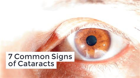 symptoms  cataracts