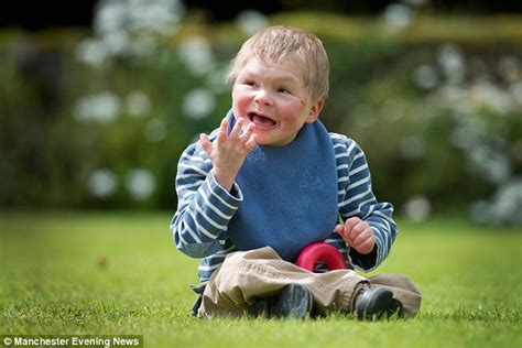 teenage boy    toddler   rare syndrome daily mail