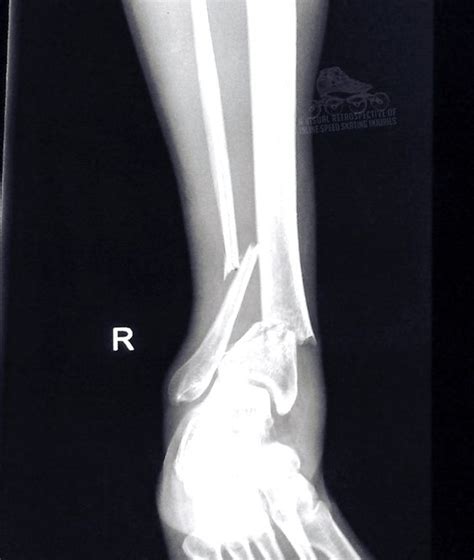 broken ankle buyxraysonline