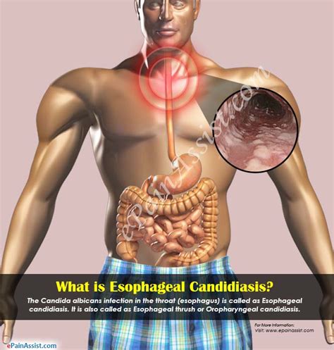 What Is Esophageal Candidiasis Symptoms Causes Treatment Prognosis 104