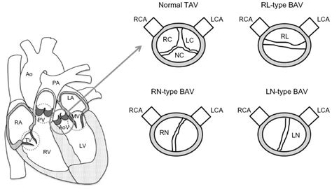 [full Text] The Hereditary Basis Of Bicuspid Aortic Valve Disease A