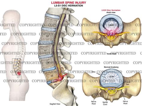 lumbar spine disc herniation female medical art works