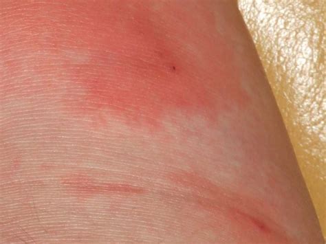 skin infection pictures  treatments