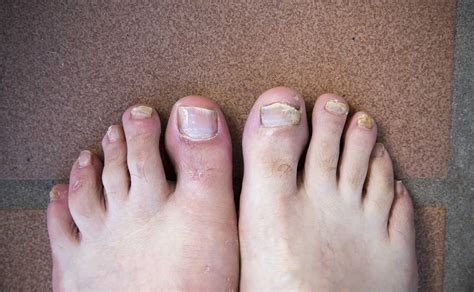 mycose des pieds les traitements efficaces pour en venir  bout