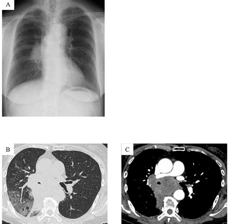 Findings On Chest Radiography And Ct A Chest Radiography Shows A