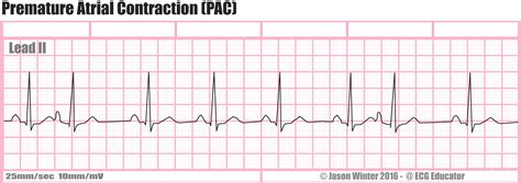 ecg educator blog premature atrial contraction pac