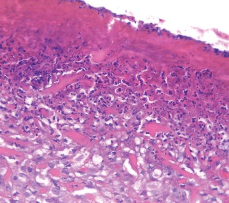 Feline Eosinophilic Granuloma Complex Ities Some Clinical