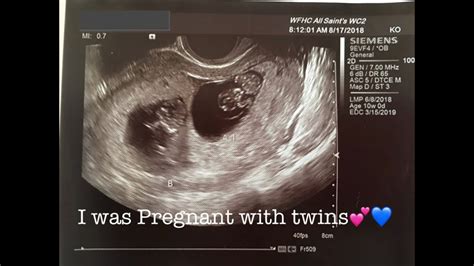 i was pregnant with twins miscarriage story youtube