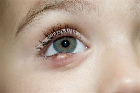 treatments  styes  eyelid bumps