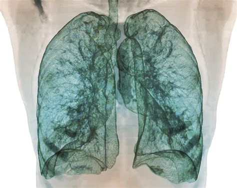 increased prevalence  ra related interstitial lung disease noted
