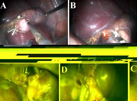 transvaginal natural orifice transluminal endoscopic surgery notes