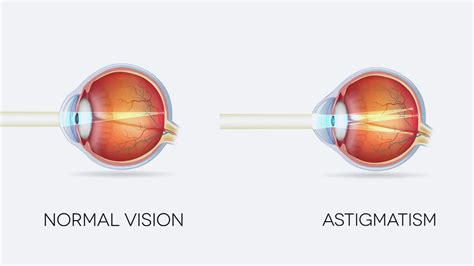 astigmatism    symptom  effect