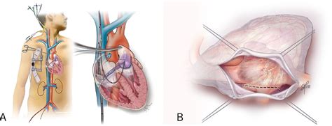 Minimally Invasive Mitral Valve Repair Heart