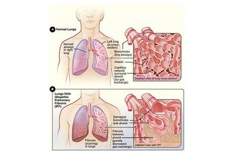 Pulmonary Fibrosis Symptoms Diagnosis And Treatment